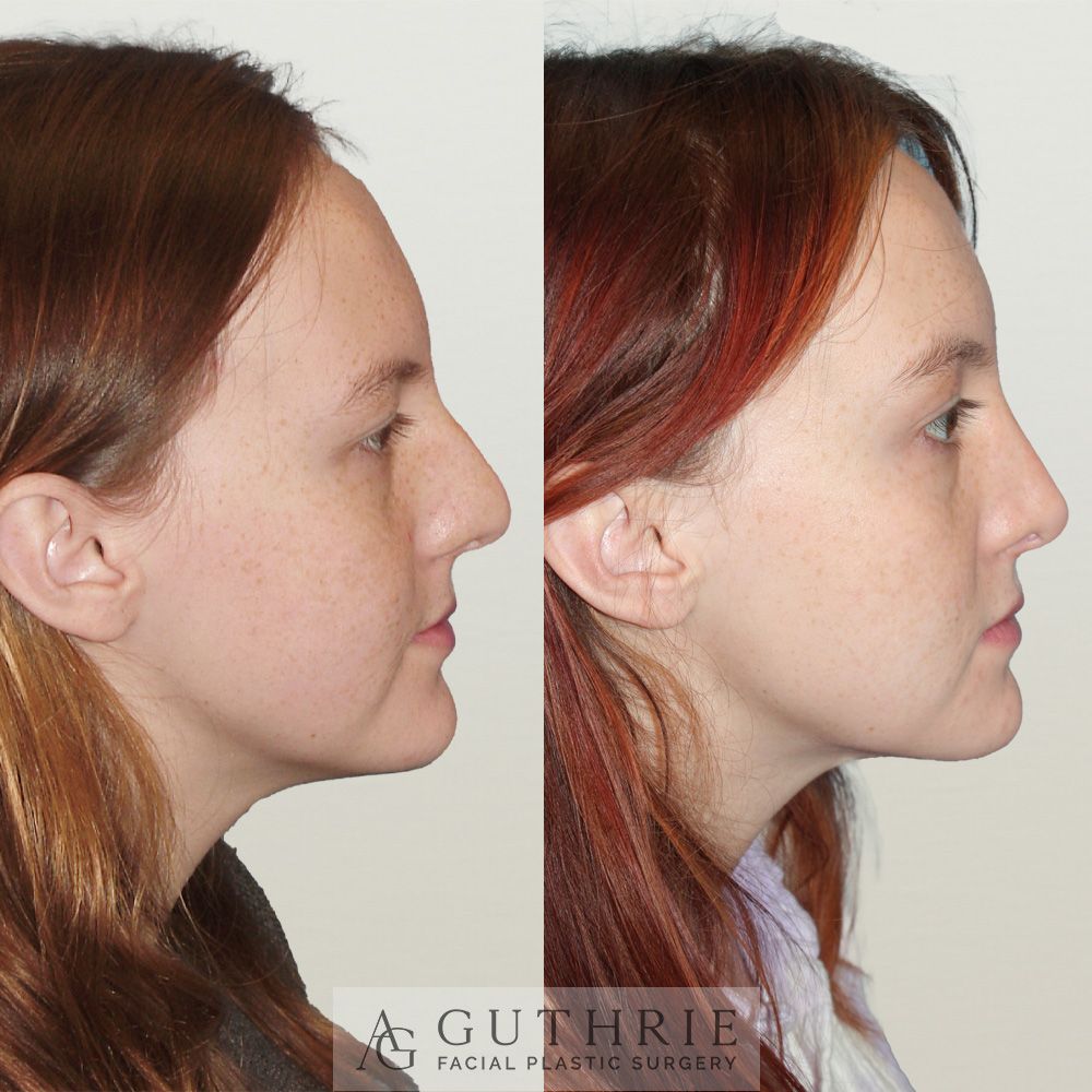 Before and After Rhinoplasty (Closed Endonasal)