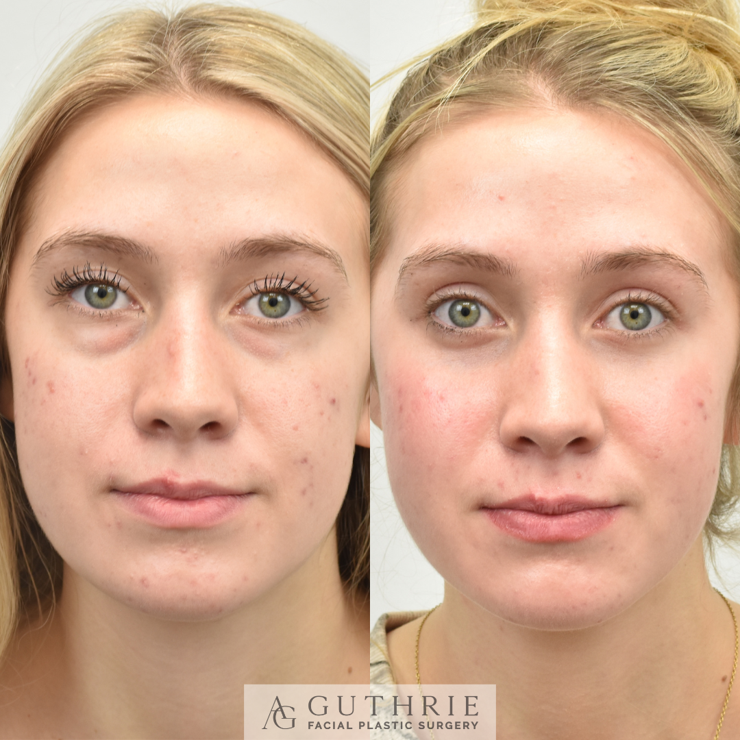 patient before and after lower blepharoplasty - guthrie facial plastic surgery brentwood tn