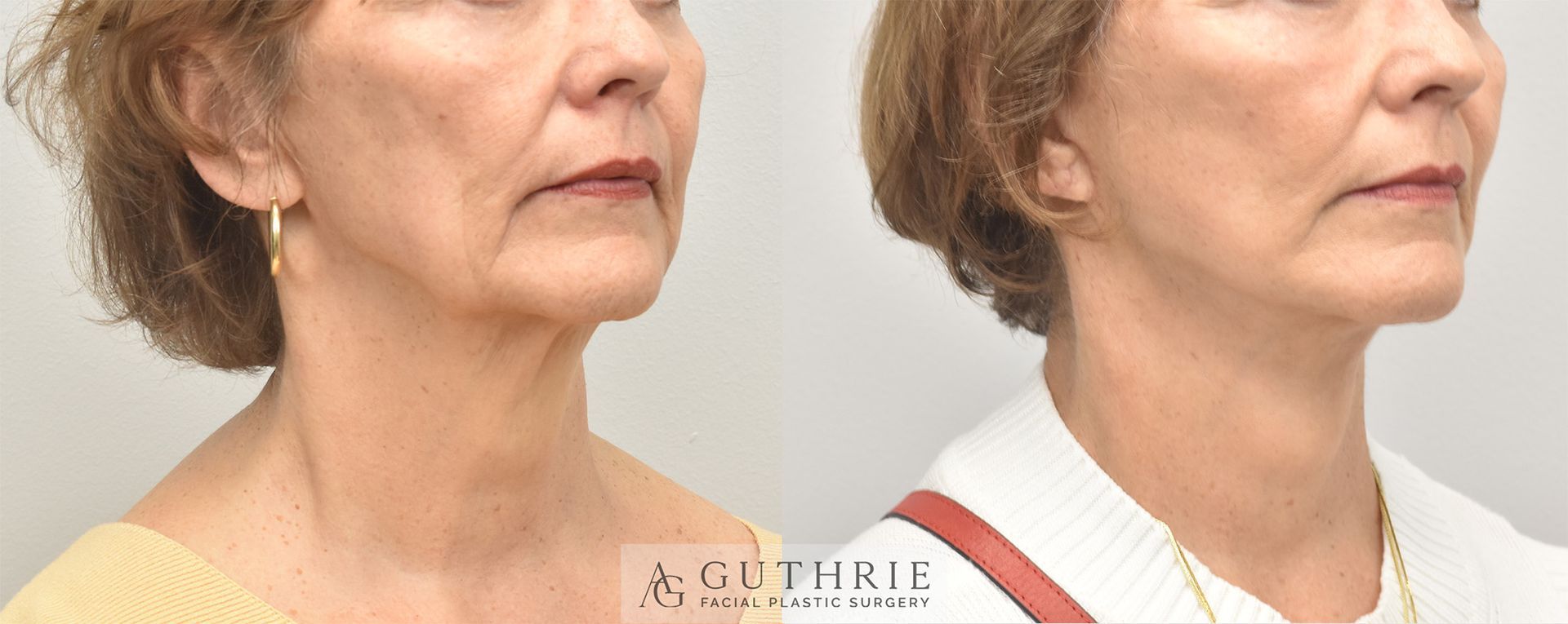 Before and After Deep Plane Lower Face and Necklift