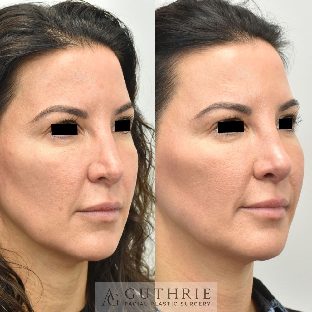 Before and After Revision Tip Rhinoplasty