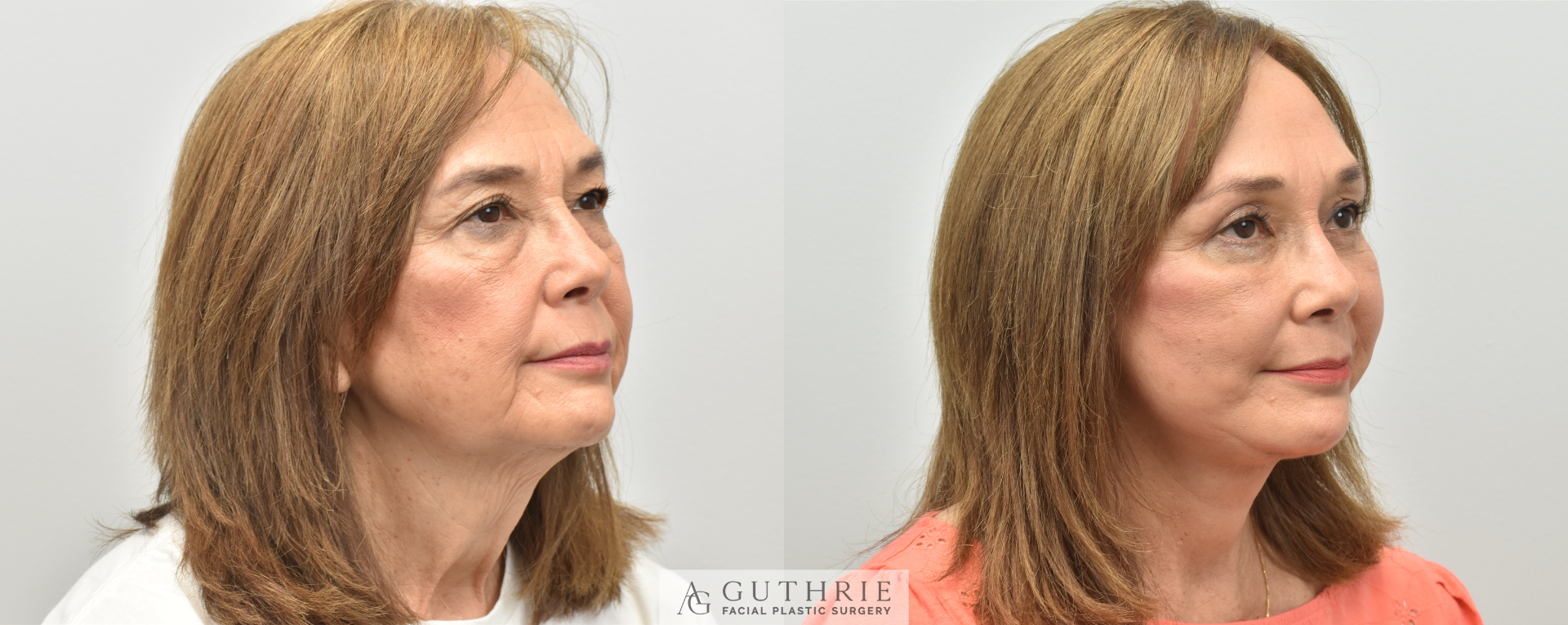 Before and After Deep Plane Face and Neck Lift, Brow Lift, Upper and Lower Blepharoplasty, Fat Transfer, CO2 Laser Resurfacing