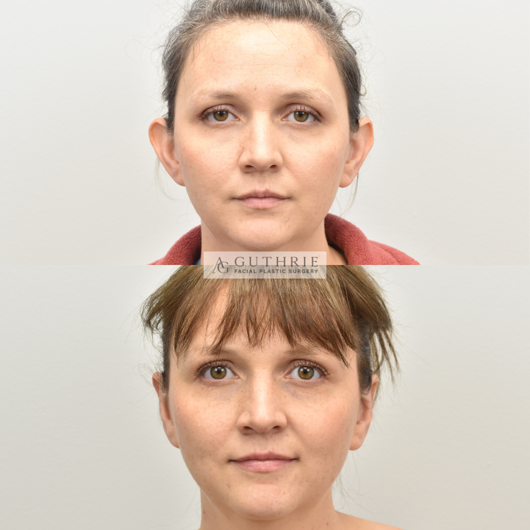patient at Guthrie Facial Plastic Surgery in Brentwood/Nashville TN before and after Otoplasty ear surgery