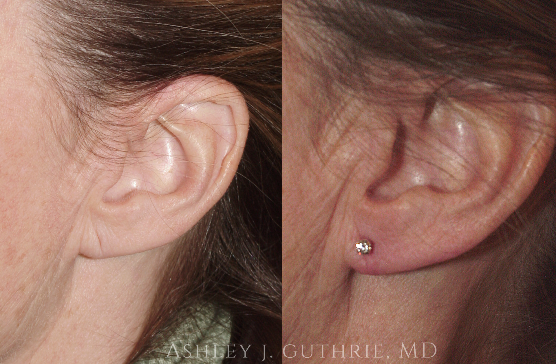 Before and 6 Weeks After Earlobe Repair
