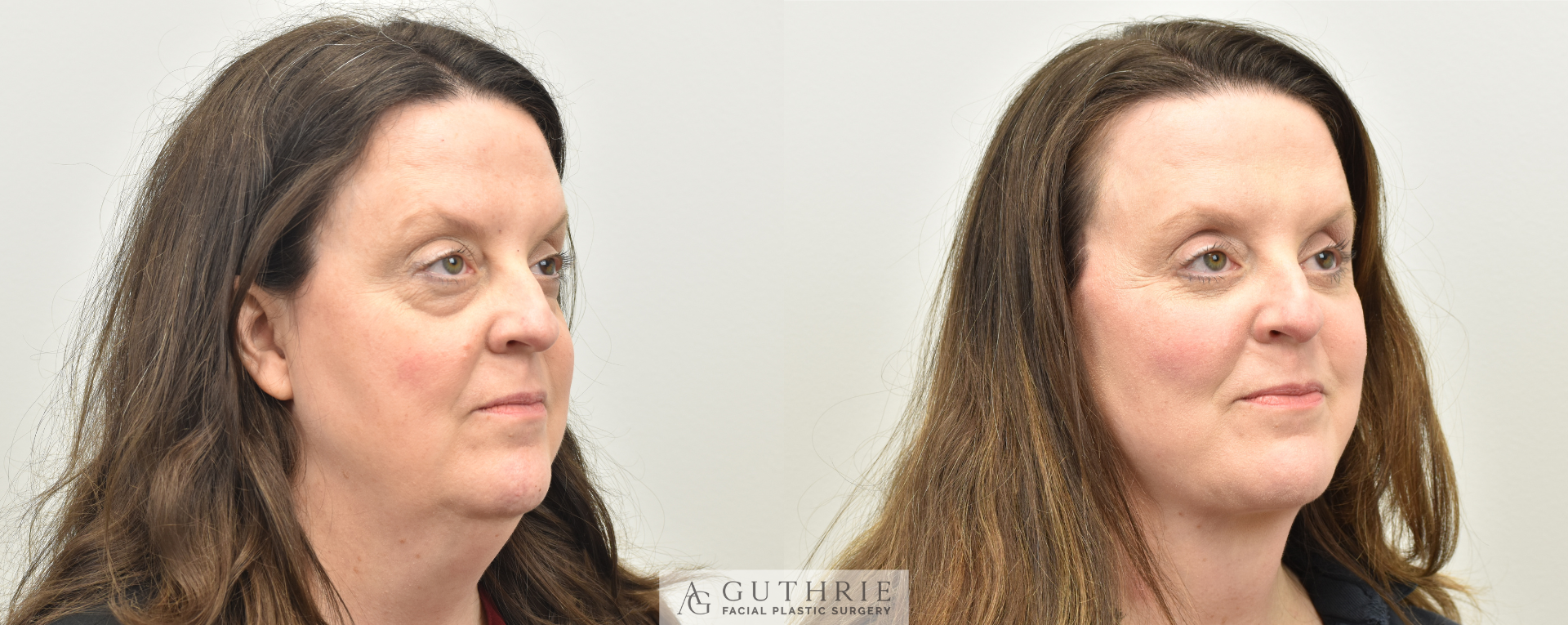 Before and After  Deep Plane Face and Neck Lift, Lower Blepharoplasty with Fat Transfer