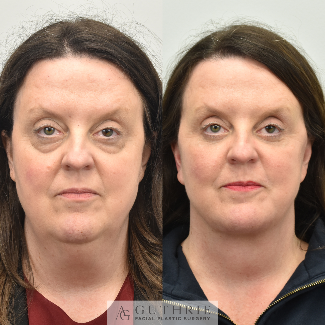 patient at guthrie facial plastic surgery before and after lower blepharoplasty