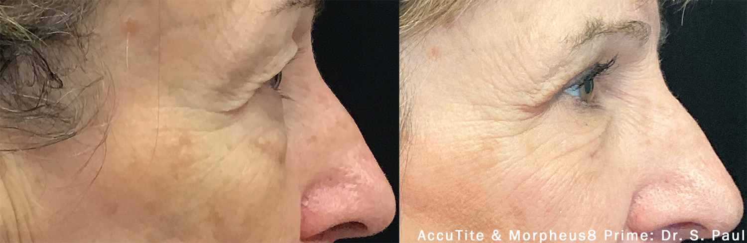 Before and After AccuTite Treatment, with Morpheus8
