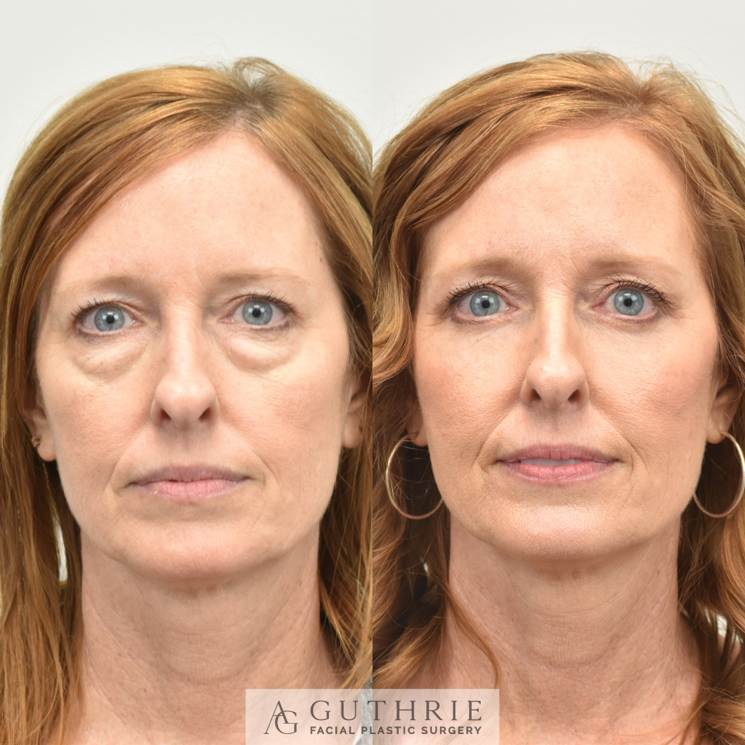 Before and After Lower Blepharoplasty with Fat Transfer