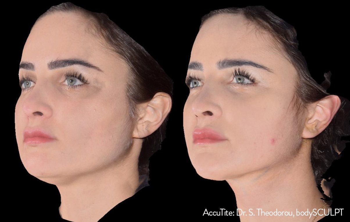 Before and After AccuTite Treatment