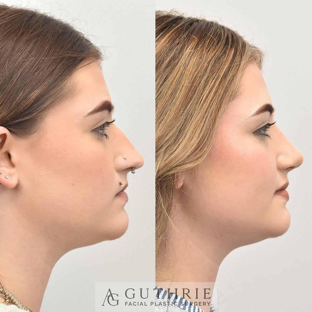 Before and After Rhinoplasty
