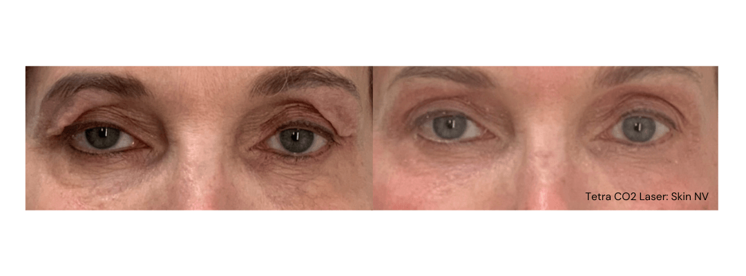 Before and After Tetra CO2 Laser Resurfacing Treatment