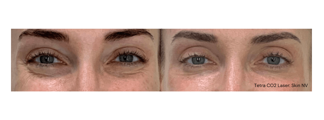 Before and After Tetra CO2 Laser Resurfacing Treatment