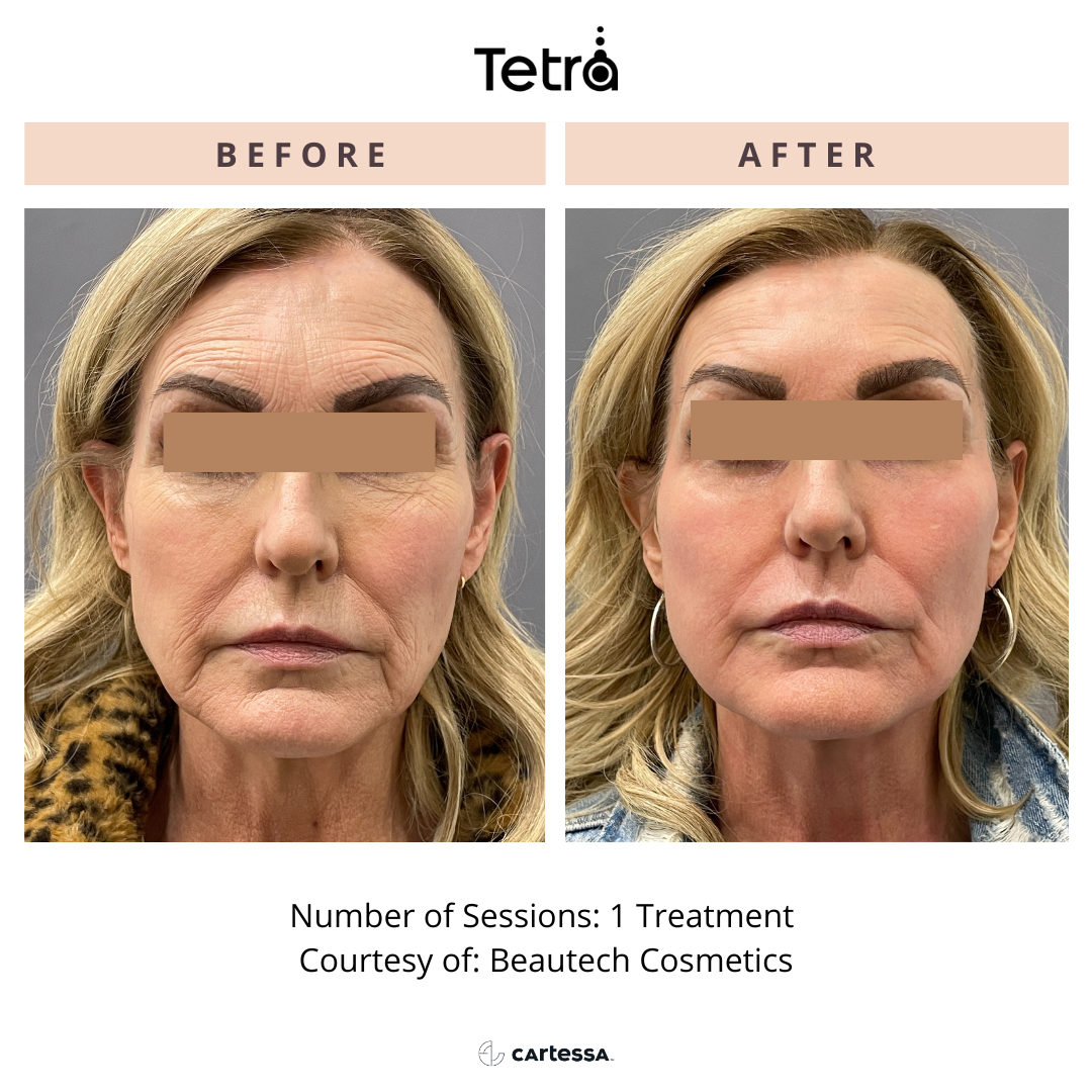 Before and After Tetra CO2 Laser Resurfacing Treatment