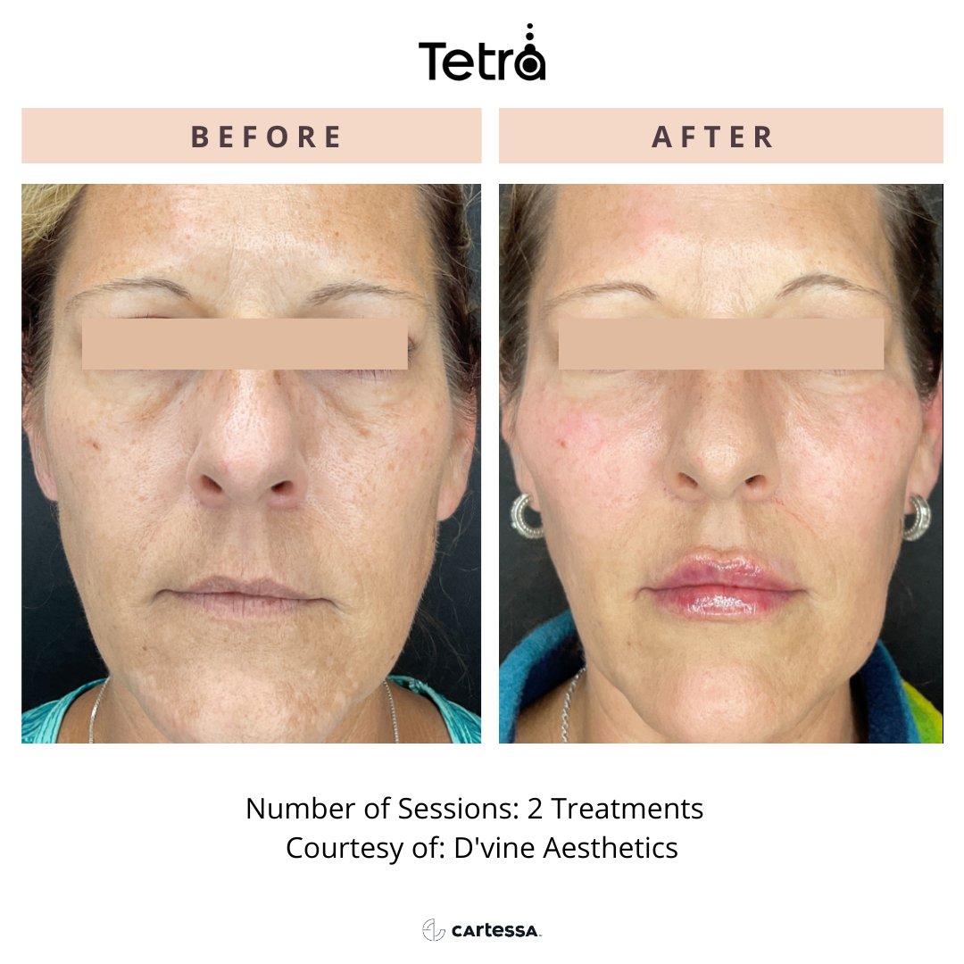 Before and After Tetra CO2 Laser Resurfacing Treatment