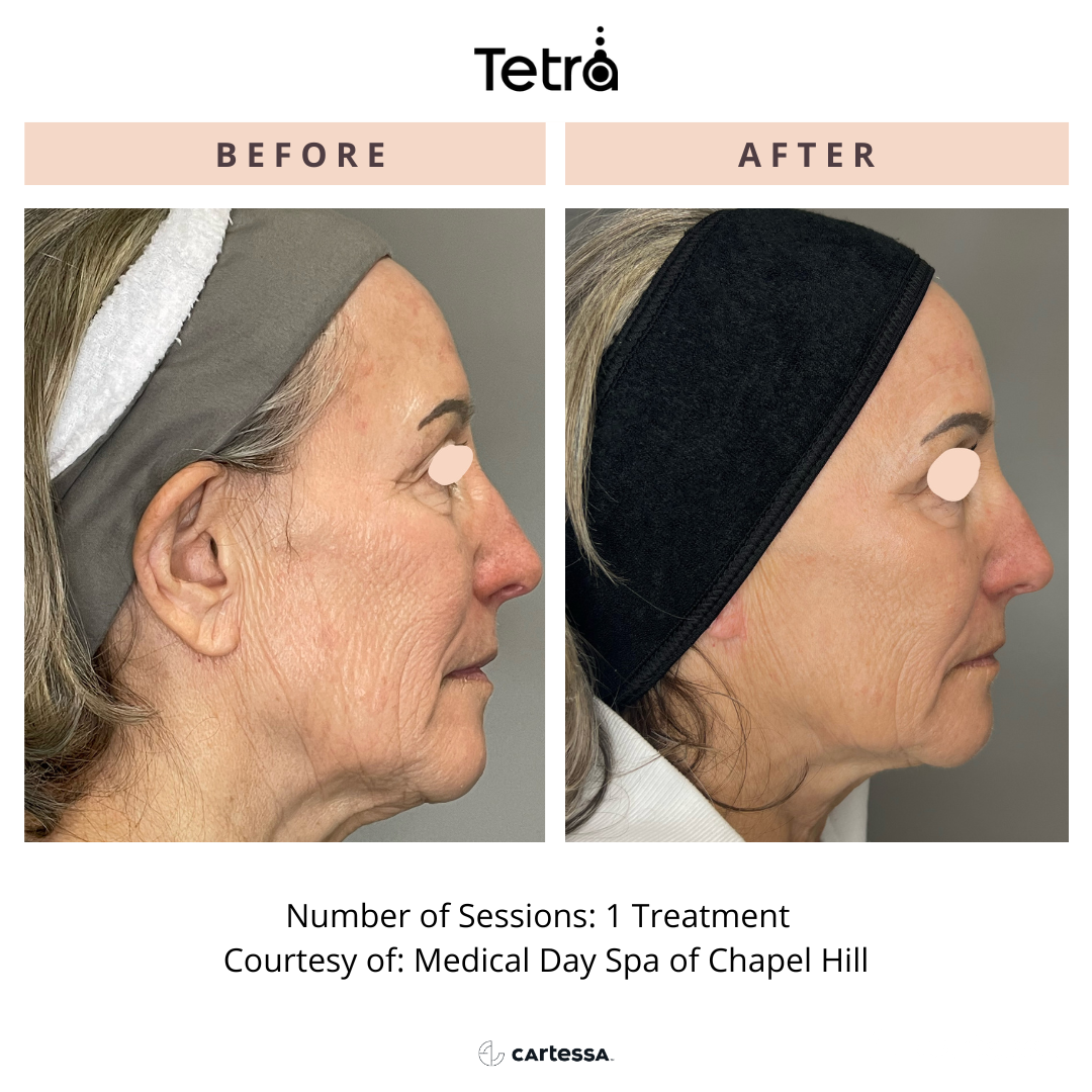Before and After Tetra CO2 Laser Resurfacing Treatment