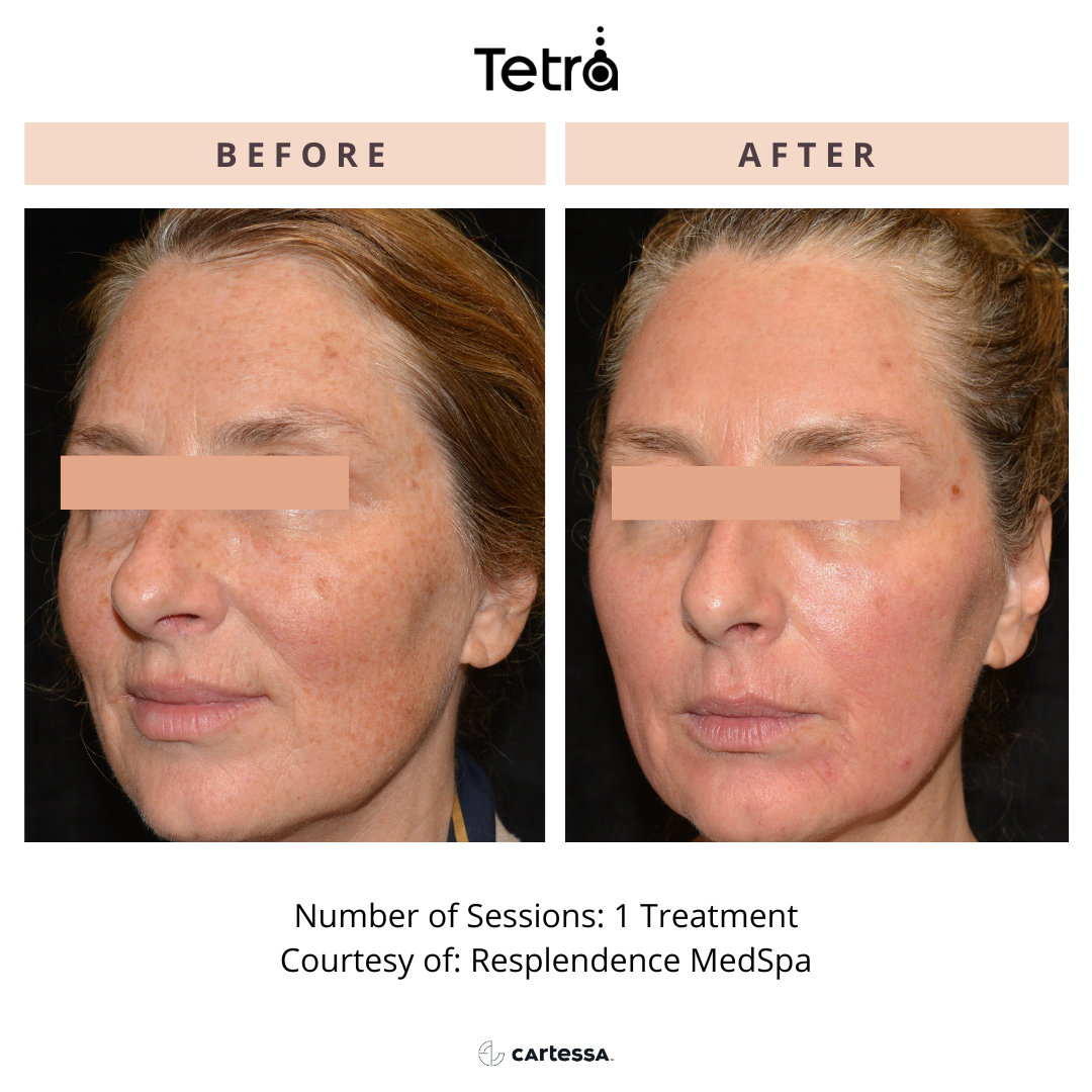 Before and After Tetra CO2 Laser Resurfacing Treatment
