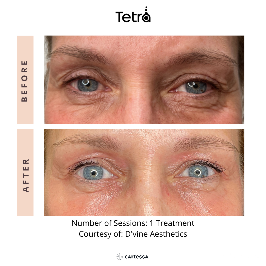 Before and After Tetra CO2 Laser Resurfacing Treatment