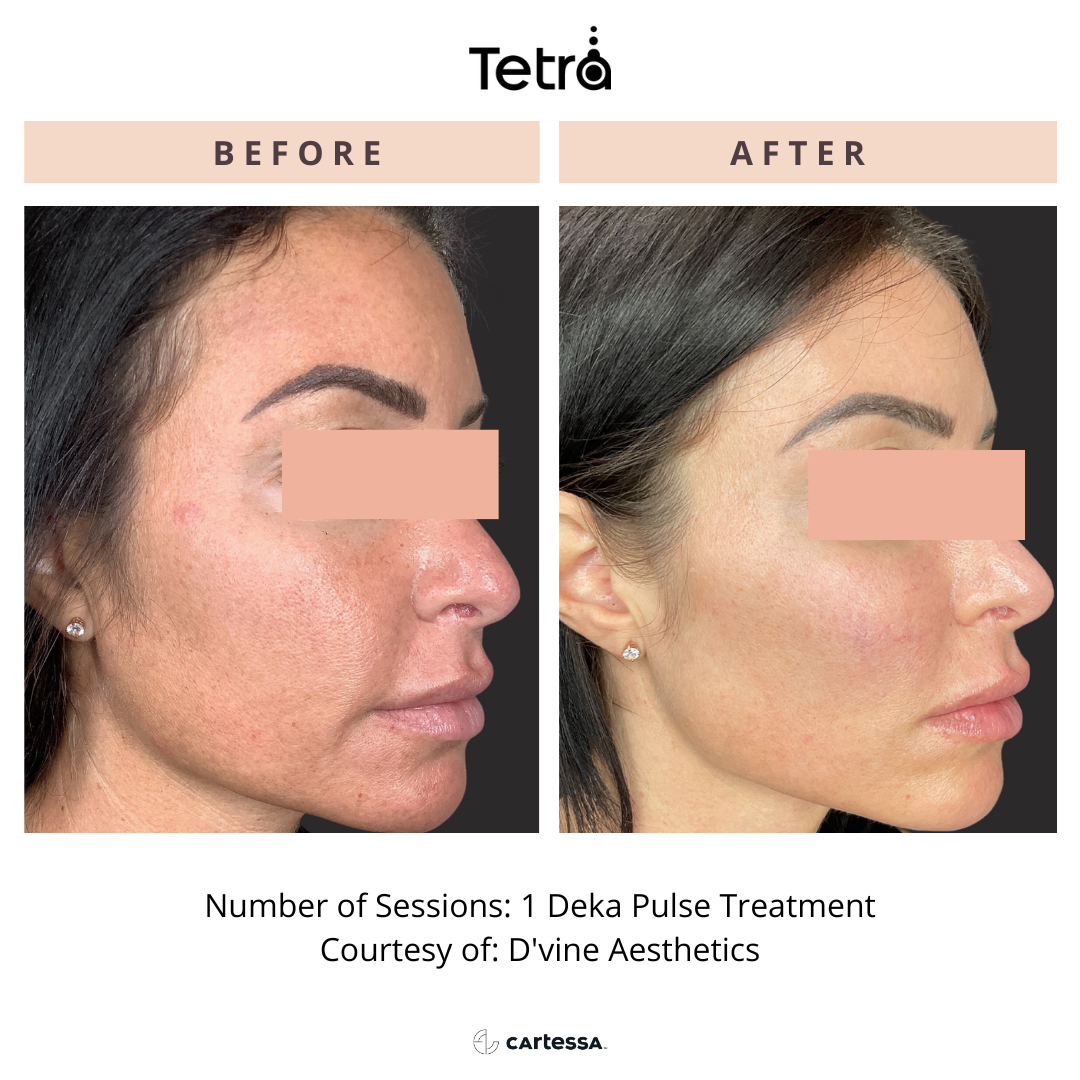 Before and After Tetra CO2 Laser Resurfacing Treatment