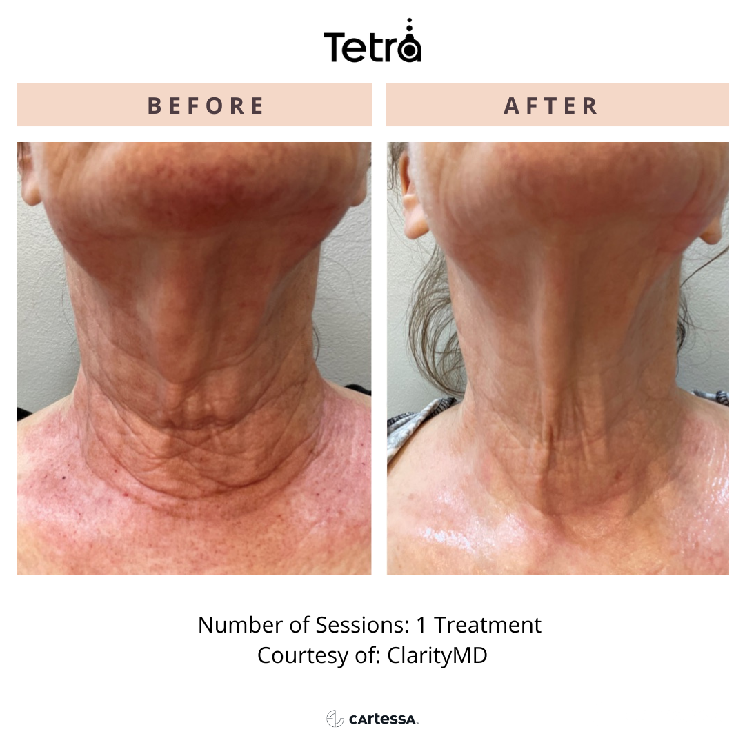 Before and After Tetra CO2 Laser Resurfacing Treatment
