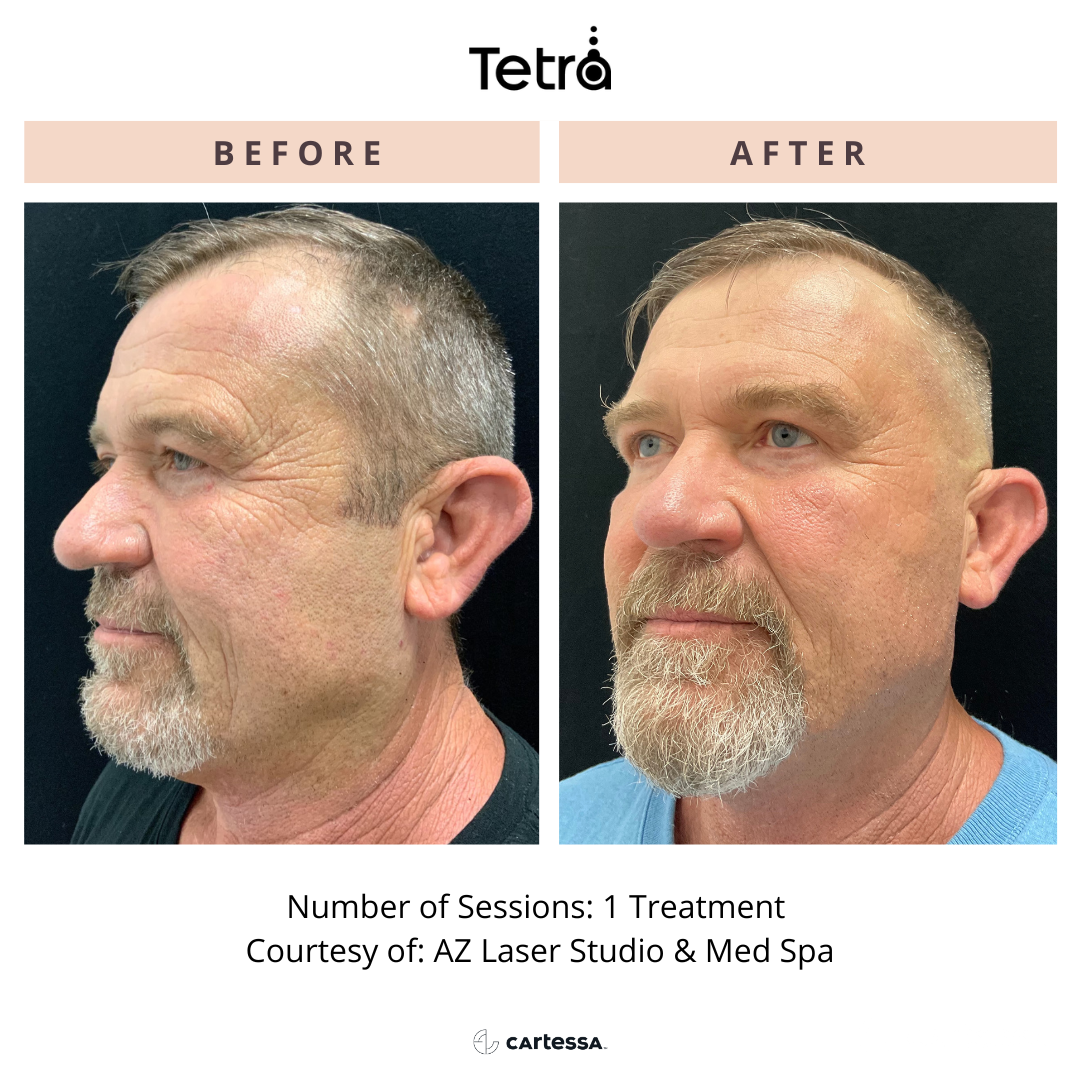 Before and After Tetra CO2 Laser Resurfacing Treatment