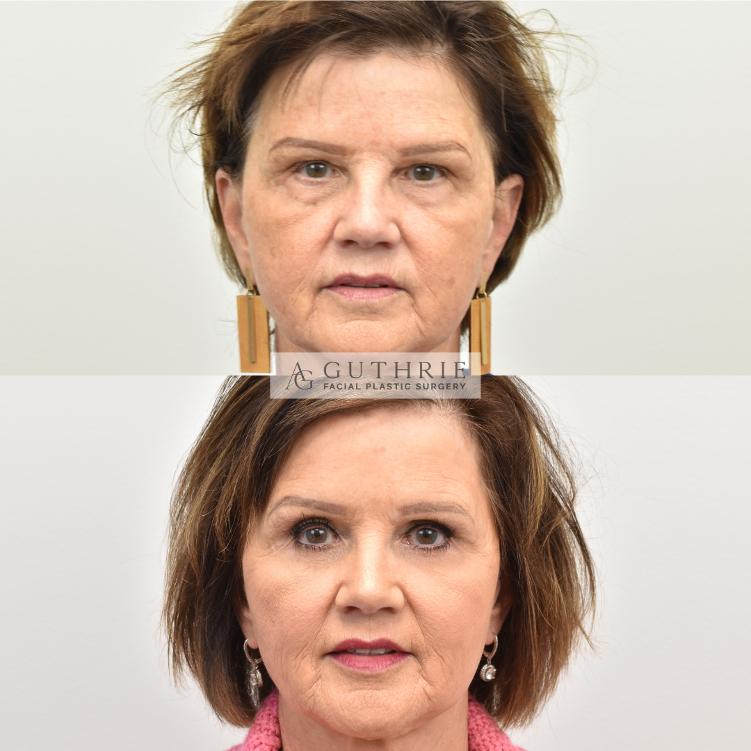 Before and After Brow Lift