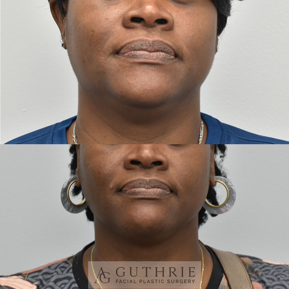 woman's face before and after FaceTite treatment