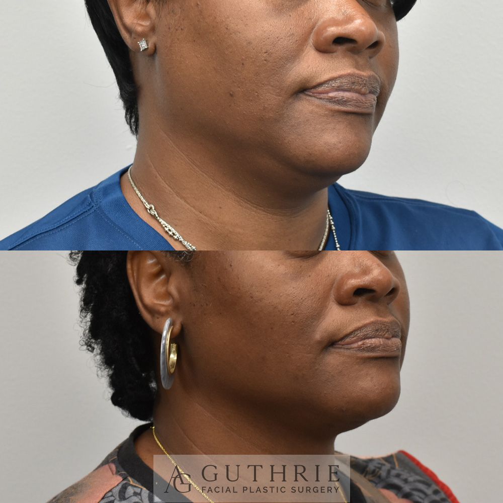 Before and After FaceTite Treatment, with Submental Liposuction
