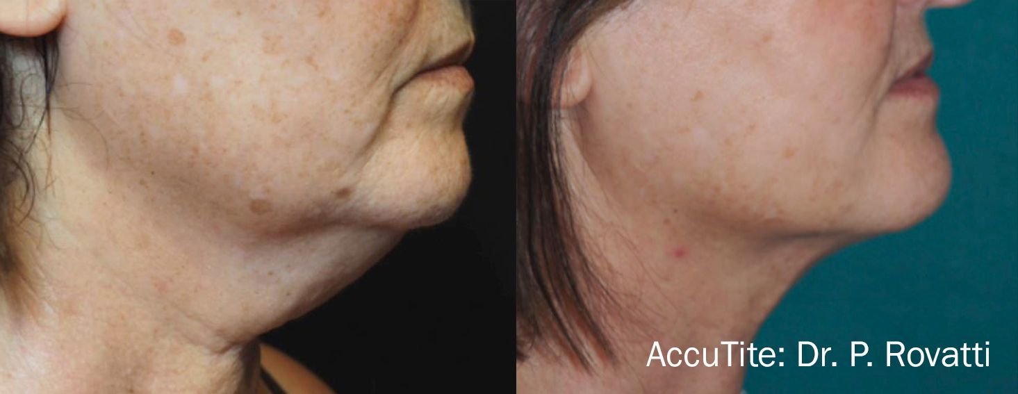 Before and After AccuTite Treatment