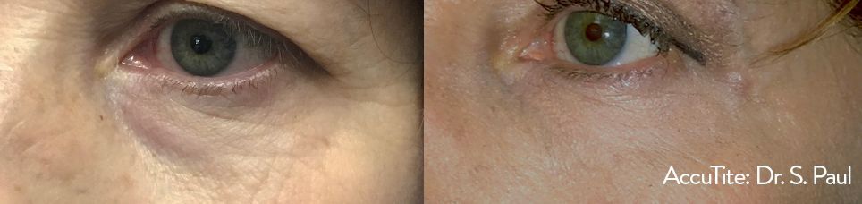 Before and After AccuTite Treatment