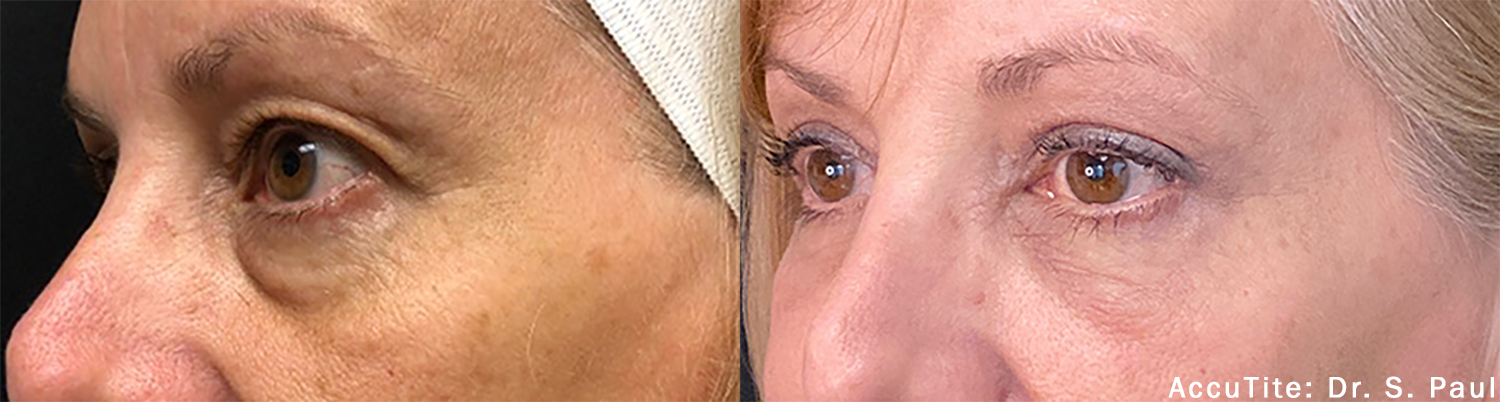 Before and After AccuTite Treatment
