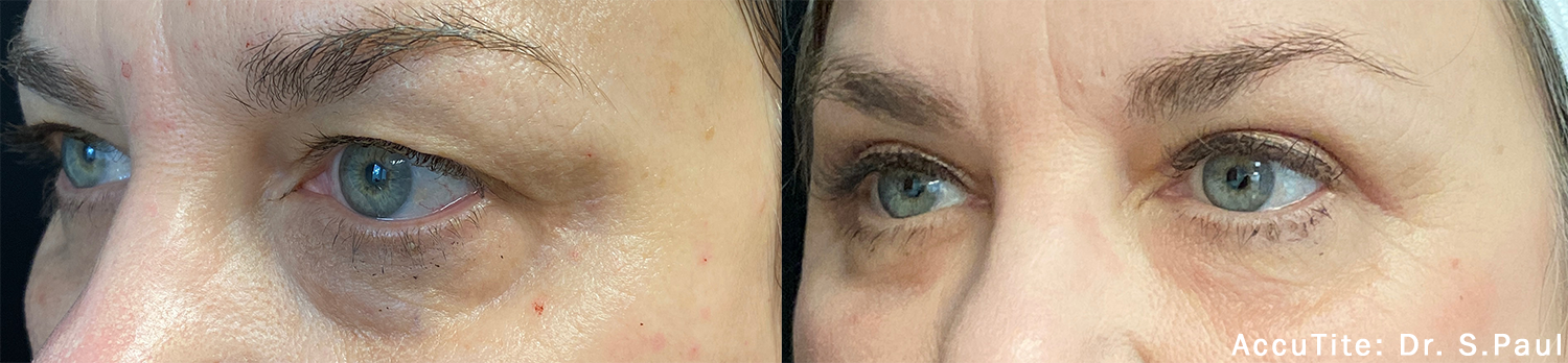 Before and After AccuTite Treatment