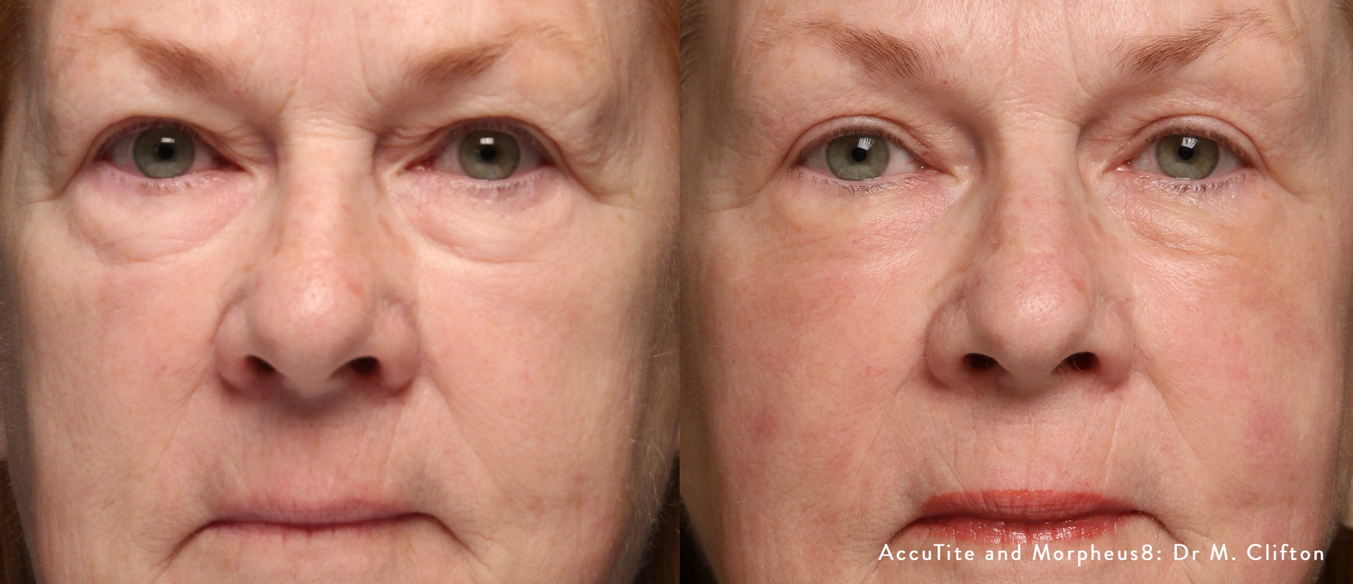 Before and After AccuTite Treatment, with Morpheus8