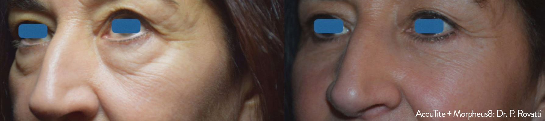 Before and After AccuTite Treatment