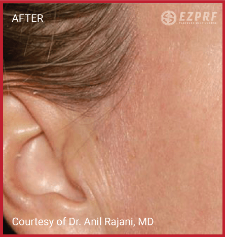 female patient after PRF treatment for facial rejuvenation