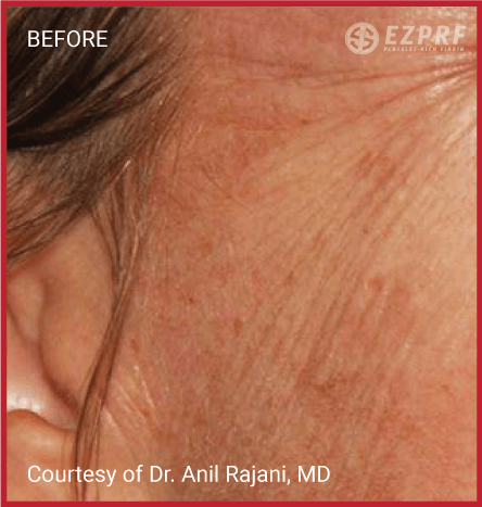 female patient before  PRF treatment for facial rejuvenation
