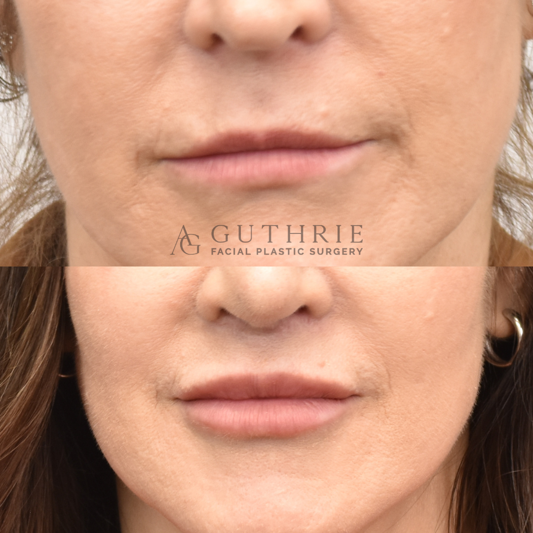 Before and After Subnasal Lip Lift with Lateral Vermillion Advancement