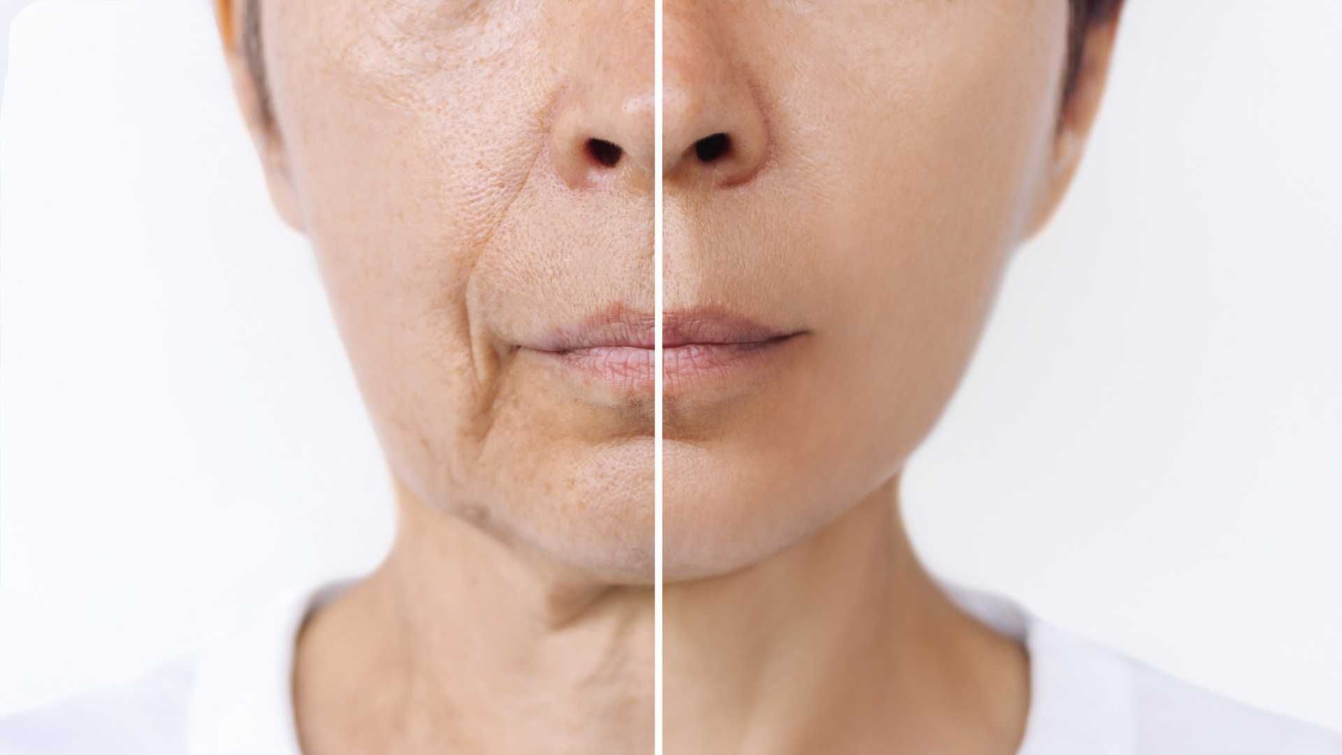 Split-face close-up showing a before-and-after comparison of facial skin texture and wrinkles