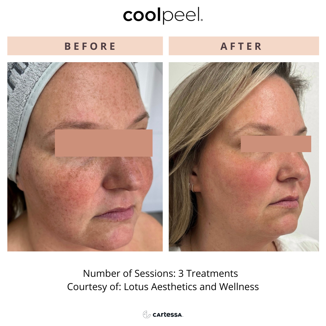 woman's face before and after CoolPeel treatment