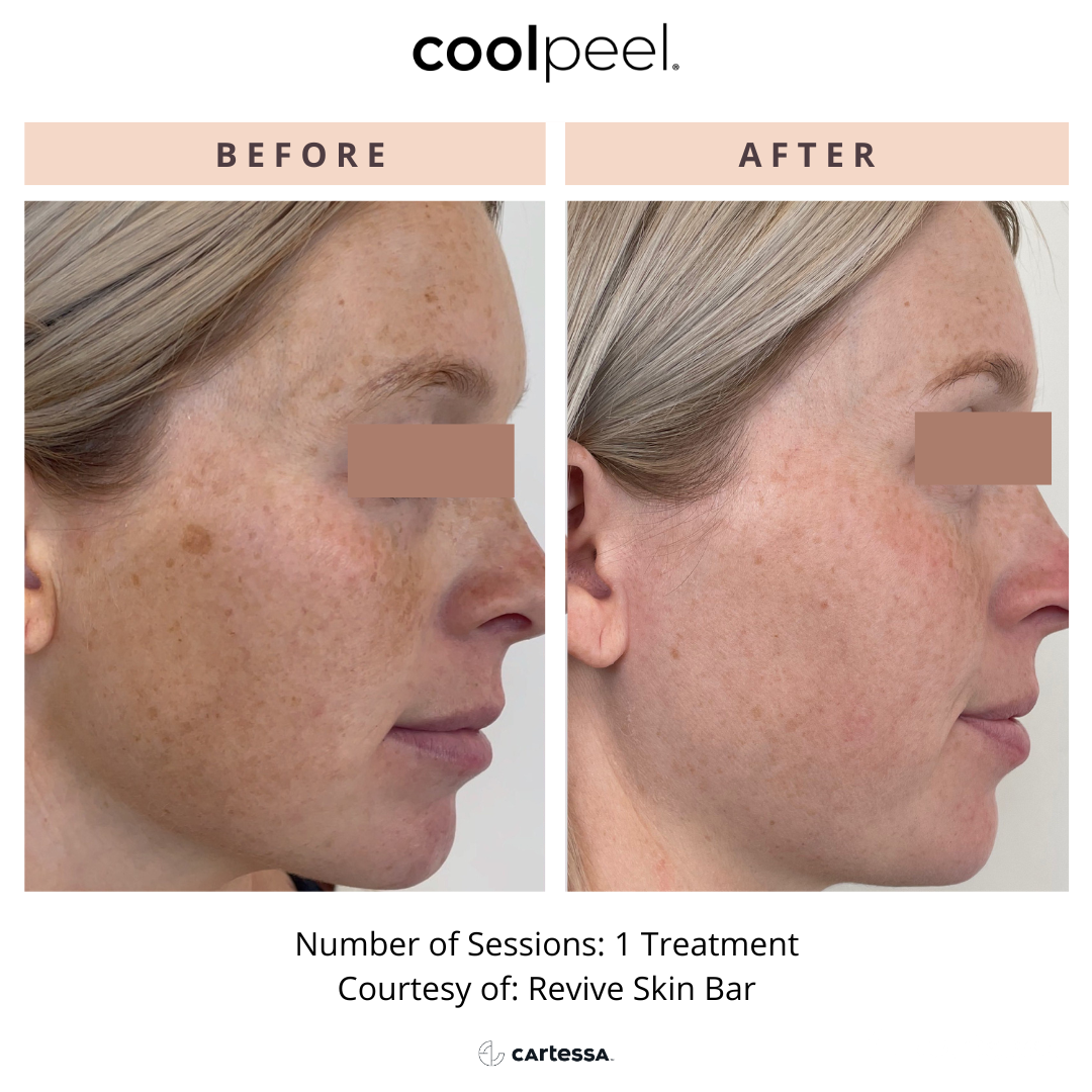 patient before and after CoolPeel laser treatment