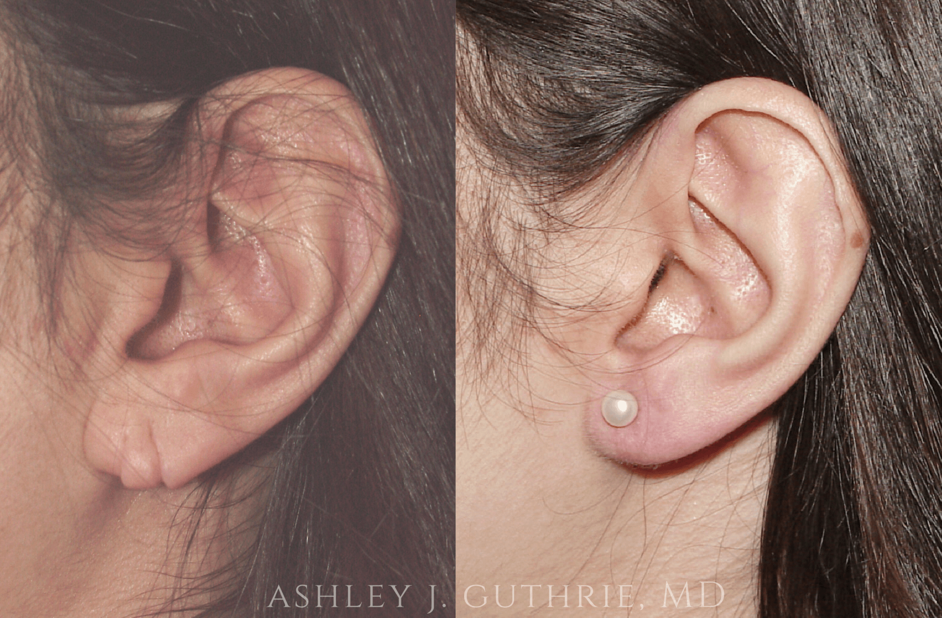 Before and 6 Weeks After Earlobe Repair