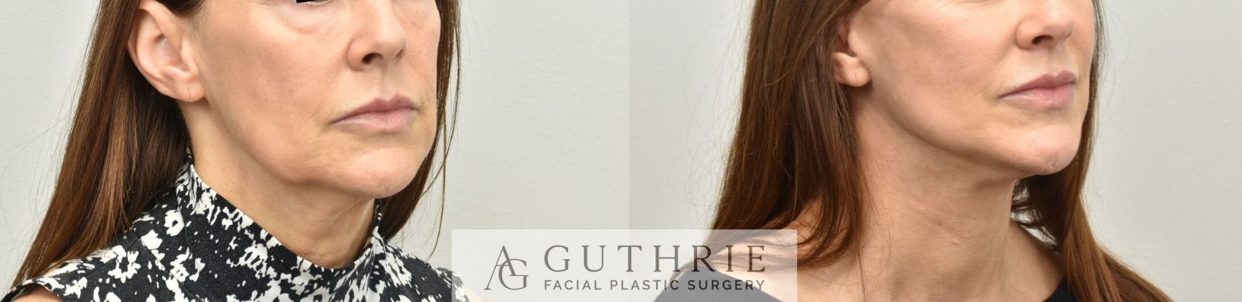 a woman's face before and after facelift procedure by Dr. Ashley Guthrie