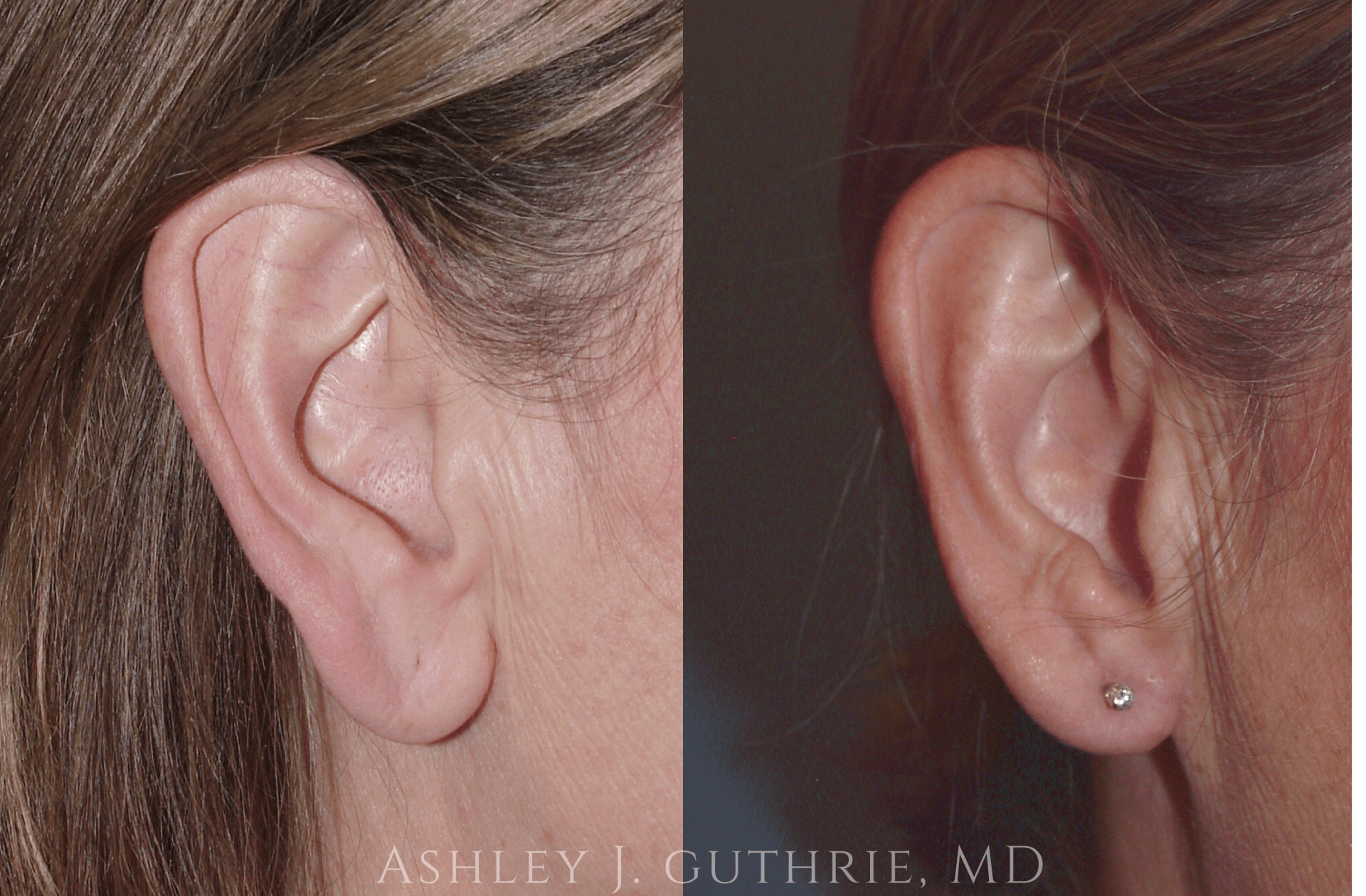 Before and 6 Weeks After Bilateral Earlobe Reduction