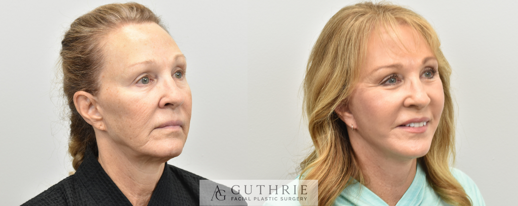 Before and After Facelift