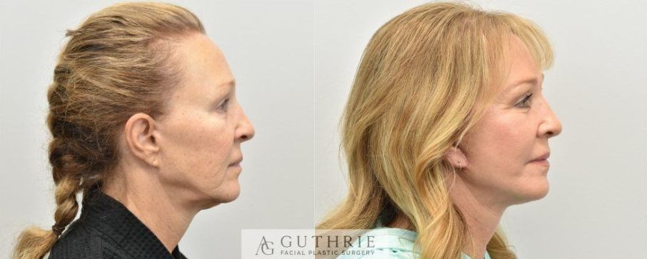 a before and after photo of a woman's face for facelift example