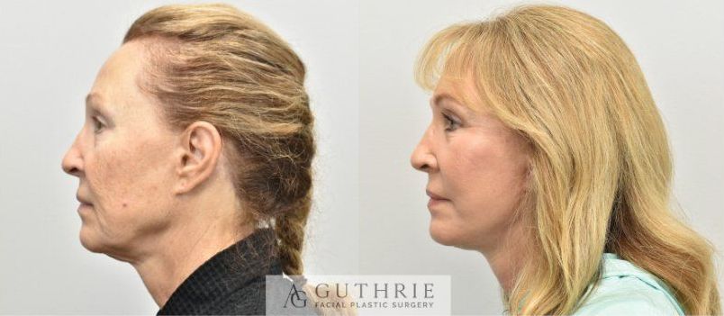a before and after photo of a woman's face for facelift example
