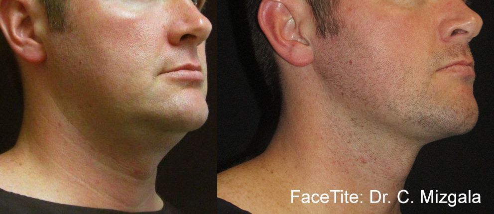 Before and After FaceTite Treatment