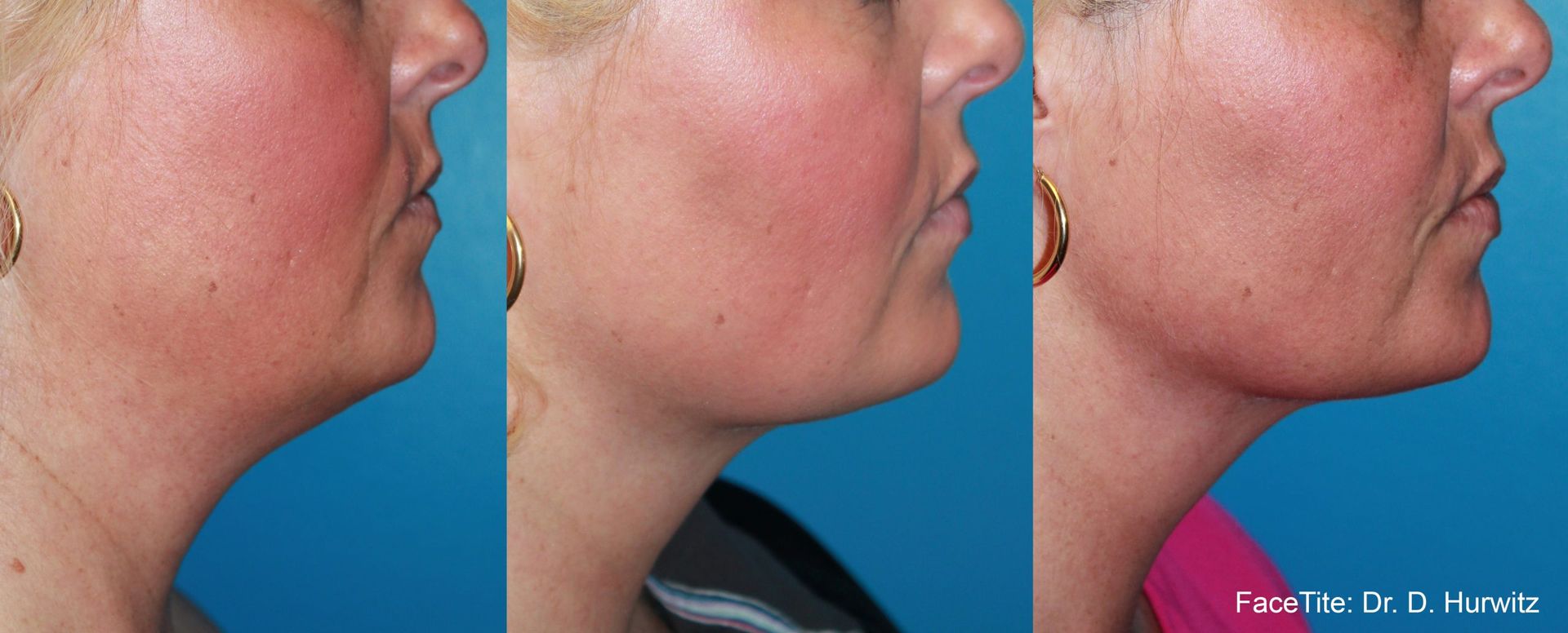 closeup of a woman's lower face and neck before and after FaceTite treatment