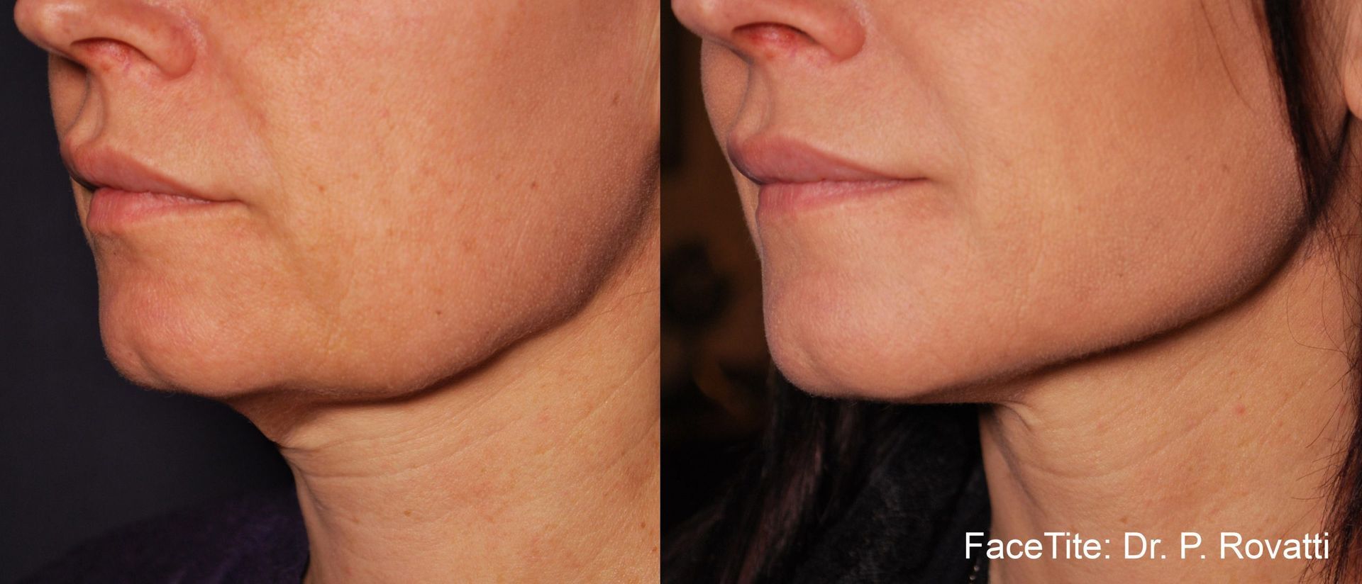 Before and After FaceTite Treatment