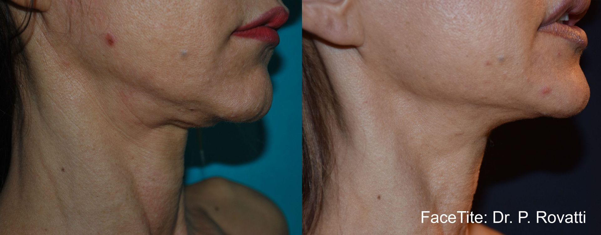 Before and After FaceTite Treatment