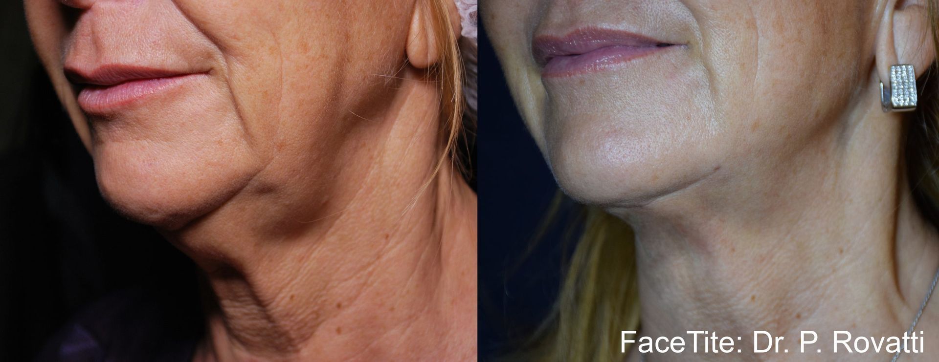 closeup of a woman's lower face and neck Before and After FaceTite Treatment