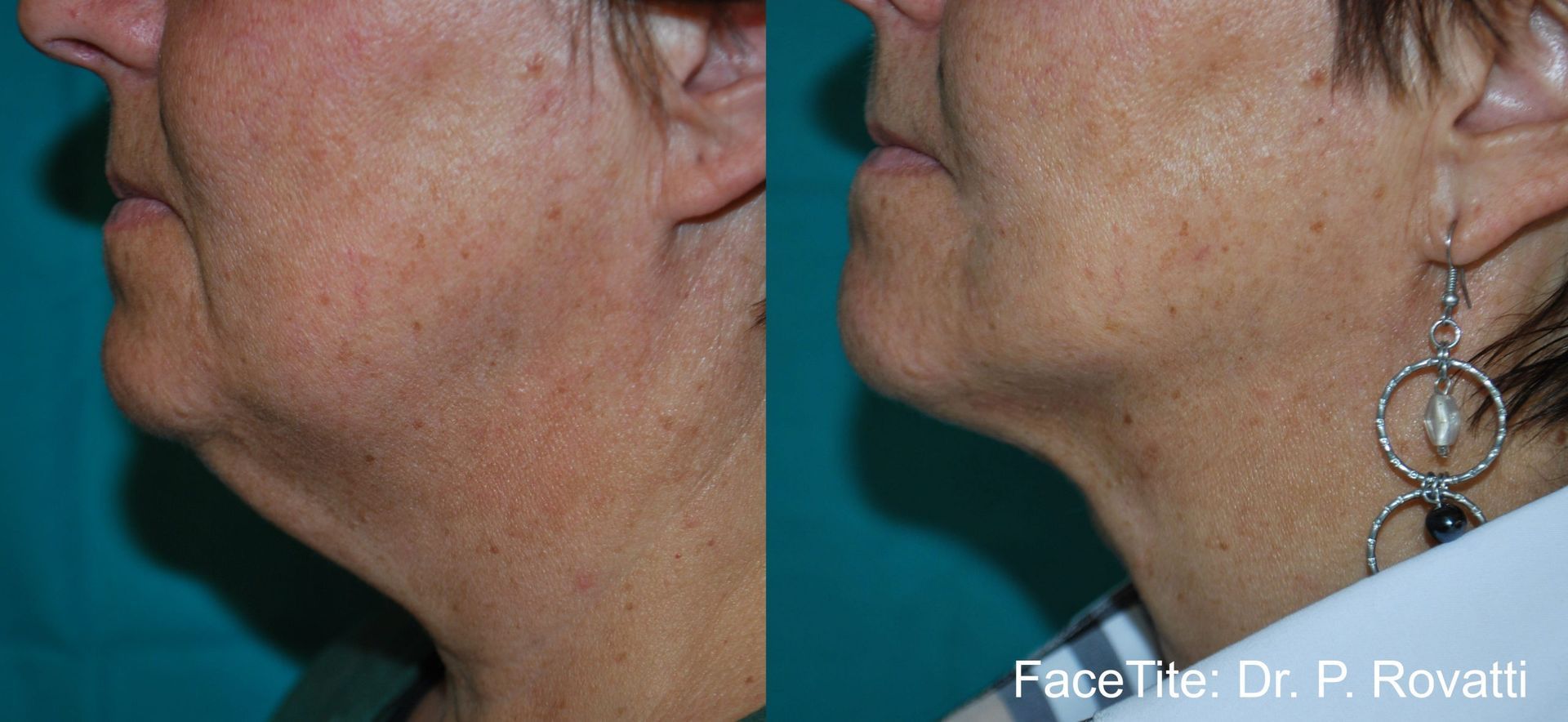 Before and After FaceTite Treatment